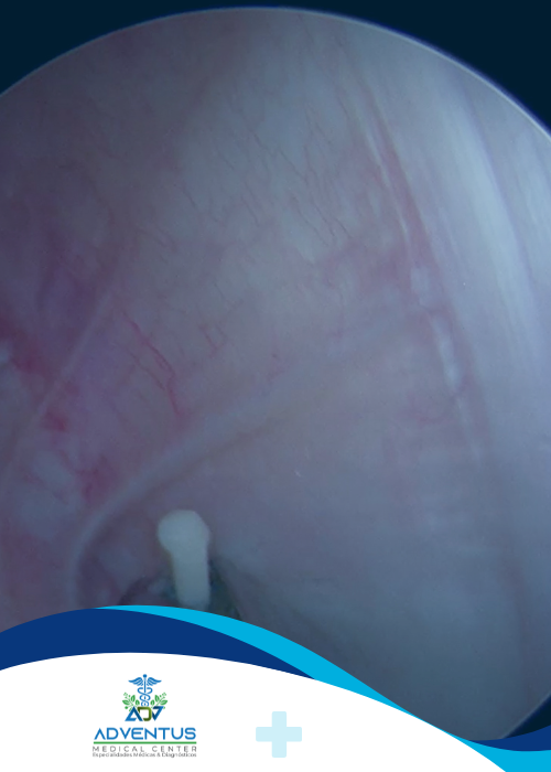 Extracción de cuerpo extraño Adventus Medical Center