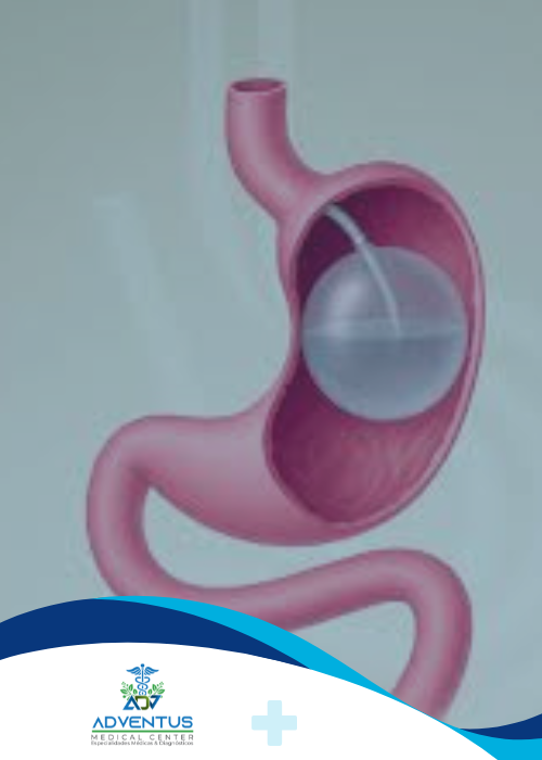 Balón intragástrico Adventus Medical Center